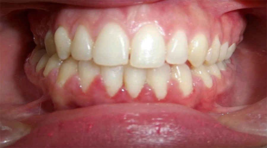 بعد تقويم وعلاج الاسنان بمركز دكتور ايمن الغمراوى -تركيب وتجميل الاسنان 5